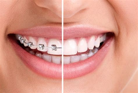 precio orthodontico lima peru